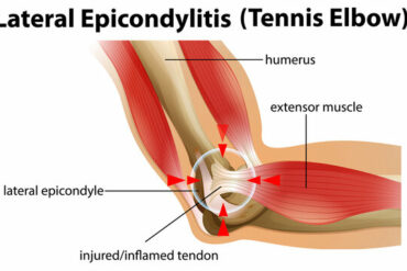 What is muscular dystrophy?