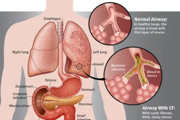 Chronic obstructive pulmonary disease (COPD)