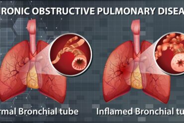 Everything you need to know about cystic fibrosis